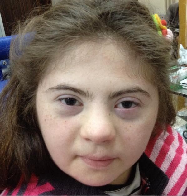 Clinical photograph of a 15-year-old female patient exhibiting phenotypic facial features characteristic of Down syndrome (Trisomy 21). The image demonstrates a flattened facial profile with a notably low-set and depressed nasal bridge. Ocular findings include upslanting palpebral fissures and prominent bilateral epicanthic folds (medial epicanthal skin folds) covering the inner canthi. Additional craniofacial features include a relatively small oral cavity and mild brachycephaly. The patient has light skin with fine freckling across the midface. This image serves as a teaching tool for medical genetics and clinical pediatrics, illustrating the classic dysmorphic facial features associated with Trisomy 21 in an adolescent. The clinical context suggests an association with Morning Glory Syndrome (MGS), though the internal ocular pathologies are not visible in this external facial view.