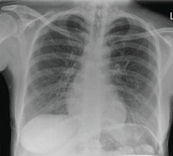 This diagnostic image is a posterior-anterior (PA) chest X-ray of an adult patient. The thoracic cage, mediastinum, and cardiac silhouette appear within normal limits for size and contour. The primary findings are localized to the left lung base, which exhibits mild peribronchial thickening and subtle linear opacities consistent with minimal scarring. There is a notable absence of definitive focal consolidation, pulmonary masses, or pleural effusions. Furthermore, no visual evidence of a Ghon complex, calcified granulomas, or hilar/mediastinal lymphadenopathy is observed, which are key negatives in the screening for tuberculosis. The costophrenic angles are sharp, and the diaphragmatic domes are well-defined. This radiograph serves as an educational example of subtle, non-specific pulmonary findings in the context of clinical infectious disease investigation.