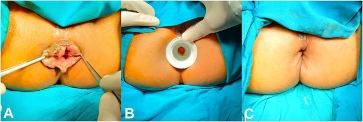 This composite of three clinical photographs documents a surgical hemorrhoidectomy procedure for Grade III or IV hemorrhoids. Panel A shows the preoperative state with significant prolapsed, irregular, reddish-brown hemorrhoidal piles protruding from the anal canal; surgical forceps are used to retract and demonstrate the extent of the prolapse. Panel B illustrates the intraoperative phase, showing the use of a circular white anal dilator to manage internal anal sphincter hypertonicity and provide surgical access to the hemorrhoidal columns. Panel C displays the immediate postoperative result, demonstrating a restored anal anatomy with no visible protruding tissue. The surgical site shows radial suture lines where the hemorrhoidal masses were excised and the mucosa was closed with simple interrupted sutures. This sequence highlights the surgical transition from symptomatic prolapse through intraoperative dilation to postoperative anatomical correction, serving as an educational resource for colorectal surgery and proctology.