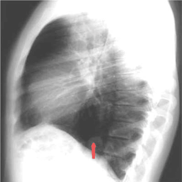 **Imaging Modality:** Lateral chest radiograph (X-ray).
**Anatomical Region:** Thoracic cavity, specifically focusing on the posterior costophrenic angle and the right hemidiaphragm.
**Observed Pathology:** Bochdalek hernia.
**Characteristic Visual Features:** The image demonstrates a localized, well-circumscribed, small round soft-tissue opacity situated in the posterior aspect of the chest. The lesion is in direct contact with the posterior portion of the right hemidiaphragm, near the retrocardiac space and the vertebral column. A red arrow highlights the specific location of the protrusion.
**Key Diagnostic Features:** The posterior location of the diaphragmatic defect is characteristic of a Bochdalek-type congenital diaphragmatic hernia. The lack of pulmonary parenchymal infiltration and the distinct margins of the opacity suggest a herniation of abdominal contents (typically omental fat or viscera) through a pleuroperitoneal hiatus. This presentation is a key differentiating feature from anterior Morgagni hernias or intrapulmonary nodules.