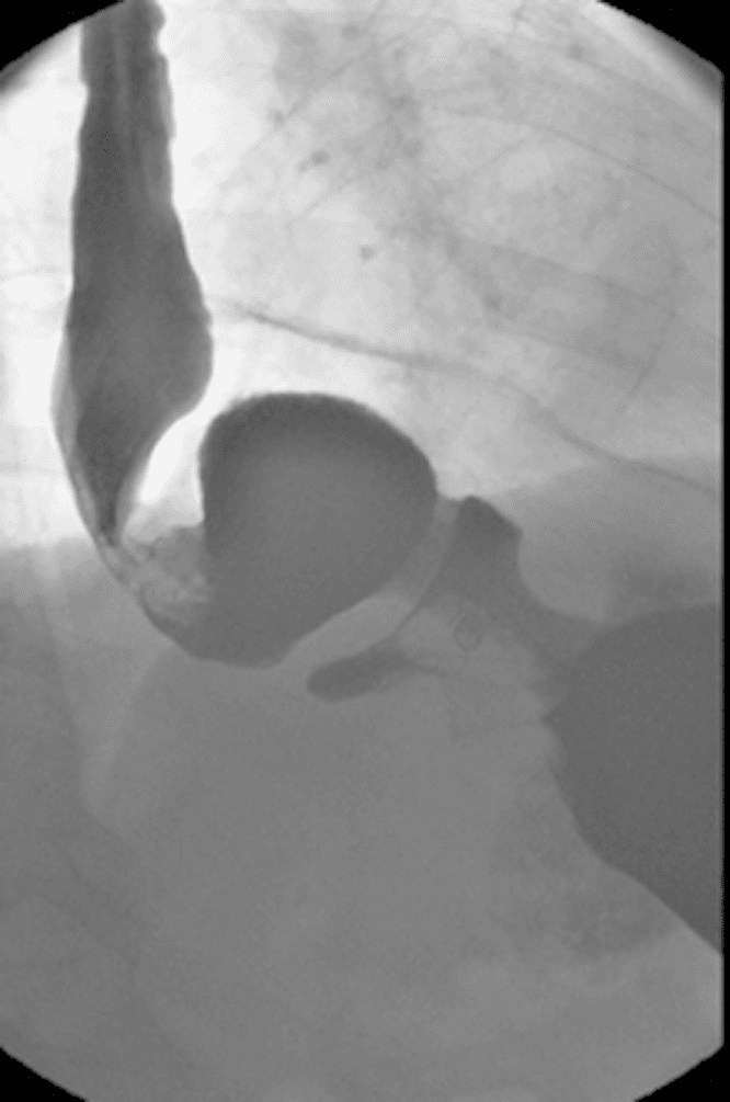 **Imaging Modality:** Barium Swallow (Fluoroscopy/Upper Gastrointestinal Series).
**Anatomical Region:** Thoraco-abdominal junction, including the distal esophagus, diaphragm, and stomach.
**Observed Pathology:** Large sliding hiatus hernia and gastroesophageal reflux.
**Characteristic Visual Features:**
The image demonstrates a significant herniation of the proximal stomach (gastric cardia and fundus) through the esophageal hiatus into the posterior mediastinum, situated above the level of the hemidiaphragm. The distal esophagus appears dilated and enters the herniated gastric pouch superiorly. Barium contrast is visible within both the esophageal lumen and the intrathoracic portion of the stomach. There is evidence of retrograde flow of contrast from the stomach back into the esophagus, indicating active gastroesophageal reflux.
**Key Diagnostic Features:**
- Presence of gastric mucosal folds above the diaphragmatic level.
- Widening of the diaphragmatic hiatus.
- Direct visualization of contrast reflux into the mid-to-distal esophagus.
- Displacement of the gastroesophageal junction into the thoracic cavity.