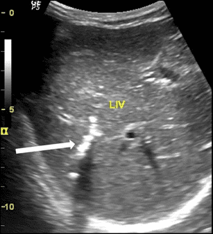 **Imaging Modality:** Abdominal Ultrasound (B-mode)
**Anatomical Region:** Right lobe of the liver, specifically focusing on the intrahepatic biliary system.
**Observed Pathology:** Intrahepatic biliary calcification.
**Characteristic Visual Features:**
The image demonstrates a focused area of linear and curvilinear hyperechoic structures within the intrahepatic ducts. These echogenic foci exhibit distinct posterior acoustic shadowing, a hallmark of dense calcification. The distribution is localized to the biliary tree of the right hepatic lobe. The surrounding hepatic parenchyma (labeled "LIV") appears relatively homogeneous but shows subtle coarse echotexture.
**Clinical Context and Differential:**
The morphology of the hyperechoic shadows is suggestive of calcified parasitic remains (such as *Ascaris lumbricoides* or liver flukes) within the biliary tract. This appearance is a key diagnostic feature for chronic or inactive biliary ascariasis, where dead worms undergo calcification.
**Key Diagnostic Cues:**
- Strong hyperechoic signal with clean posterior shadowing.
- Tubular or curvilinear shape conforming to the ductal anatomy.
- Localization within the intrahepatic ducts rather than the gallbladder.