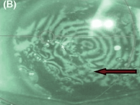 **Imaging Modality:** Placido disc-based corneal topography (videokeratoscopy).
**Anatomical Region:** Anterior segment of the eye, specifically the corneal surface.
**Observed Pathology:** Climatic droplet keratopathy (CDK).
**Characteristic Visual Features:** The image demonstrates severe irregularity and distortion of the Placido rings reflected off the corneal tear film. In the central and paracentral regions, indicated by a red arrow, the concentric mires show significant breakage, crowding, and wavy deformation (mires distortion). This pattern indicates a highly irregular corneal surface and loss of optical smoothness. There is a visible breakdown of the circular mire integrity, correlating with the presence of subepithelial deposits and opacities characteristic of advanced droplet keratopathy.
**Diagnostic Differentiating Features:** Unlike the regular steepening seen in keratoconus, this image shows diffuse, chaotic distortion and "mire dropout," reflecting the basement membrane changes and proteinaceous subepithelial accumulation typical of degenerative keratopathies. The distortion is non-orthogonal and irregular, signifying high-order aberrations and severe irregular astigmatism.