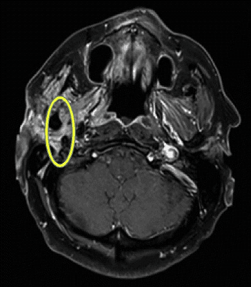 **Imaging Modality:** Axial Magnetic Resonance Imaging (MRI); T1-weighted Turbo Spin Echo (TSE) with Fat Suppression (FS) and gadolinium contrast enhancement.
**Anatomical Region:** Axial section of the skull base and head at the level of the internal auditory canals and the parotid glands.
**Observed Pathology:** Abnormal thickening and intense contrast enhancement of the right facial nerve (Cranial Nerve VII). The enhancement involves the extracranial segment as it exits the stylomastoid foramen and traverses the parotid region.
**Characteristic Visual Features:**
* **Signal Intensity:** High signal intensity (bright) on post-contrast T1-weighted imaging, indicating significant enhancement.
* **Morphology:** Marked focal thickening and perineural enhancement of the nerve, highlighted within the yellow elliptical marker.
* **Symmetry:** Asymmetrical presentation when compared to the contralateral (left) facial nerve, which appears normal in caliber and enhancement.
**Clinical Context:** These findings are characteristic of perineural spread of tumor, inflammatory processes (e.g., Bell's palsy), or neoplastic involvement (e.g., facial nerve schwannoma or parotid malignancy extending along the nerve path).
**Diagnostic Cues:** Post-contrast enhancement combined with fat suppression allows for clear visualization of pathology against the suppressed signal of adjacent fatty tissues.