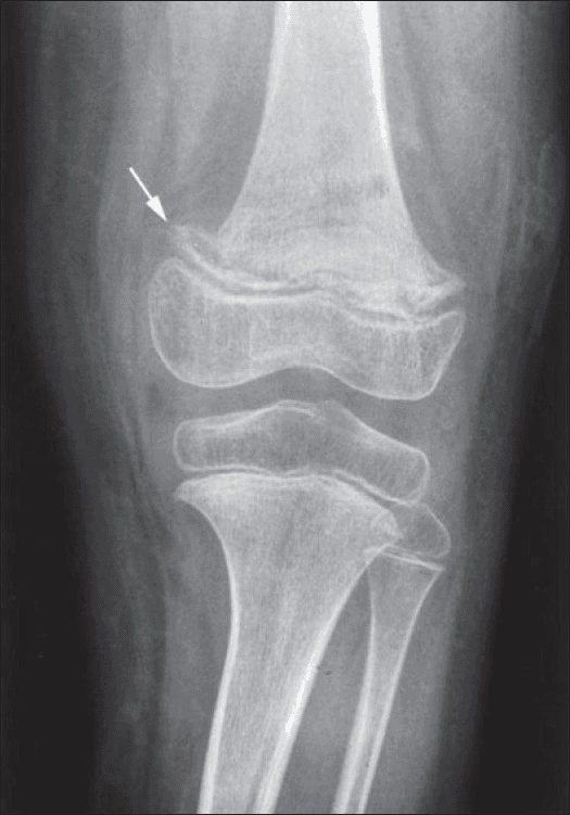**Imaging Modality:** Conventional Radiography (X-ray).
**Anatomical Region:** Pediatric knee joint, including the distal femur and proximal tibia/fibula.
**Observed Pathology:** Findings consistent with infantile scurvy (hypovitaminosis C).
**Characteristic Visual Features:**
* **White Line of Frankel:** A dense, transverse radiopaque band is visible at the zone of provisional calcification in the distal femoral metaphysis (indicated by the white arrow).
* **Pelkan Spur:** Marginal lateral bony protrusion extending from the metaphysis, resulting from the outward displacement of the zone of provisional calcification.
* **Trümmerfeld Zone:** A lucent, scorbutic zone of rarefaction located immediately proximal to the dense metaphyseal line.
* **Wimberger Ring Sign:** Sclerotic circumferential rimming around the epiphyseal centers of ossification, which appear osteopenic or "ground-glass" centrally.
* **Generalized Osteopenia:** Diffuse reduction in bone mineral density throughout the visualized long bones.
**Key Diagnostic Features:** The combination of a dense metaphyseal white line, metaphyseal spurring (Pelkan spur), and ring-shaped epiphyses is pathognomonic for skeletal scurvy in a pediatric patient.