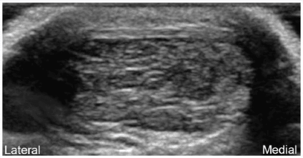 **Imaging Modality:** Musculoskeletal Ultrasound (grayscale)
**Anatomical Region:** Posterior ankle, transverse view of the Achilles tendon.
**Observations:**
The image shows a transverse cross-section of the mid-portion Achilles tendon. Significant morphological changes are present, characterized by marked fusiform thickening and an overall increase in the cross-sectional area of the tendon.
**Pathology/Features:**
* **Echo-texture:** There is a loss of the normal organized fibrillar pattern. The tendon displays heterogeneous echogenicity with prominent, ill-defined hypoechoic (darker) areas.
* **Distribution:** The hypoechoic changes are localized primarily to the central and medial aspects of the tendon body. This distribution corresponds to the anatomical territory of the soleus-derived fascicles.
* **Borders:** The paratenon appears slightly thickened, though the anterior and posterior margins of the tendon remain identifiable despite the internal reorganization.
**Diagnostic Context:**
These sonographic findings are highly indicative of mid-portion Achilles tendinopathy (tendinosis). The specific localization to the medial and central fascicles suggests selective involvement of the soleus component of the Achilles complex. No discrete anechoic clefts suggestive of a full-thickness tear are visualized in this view.