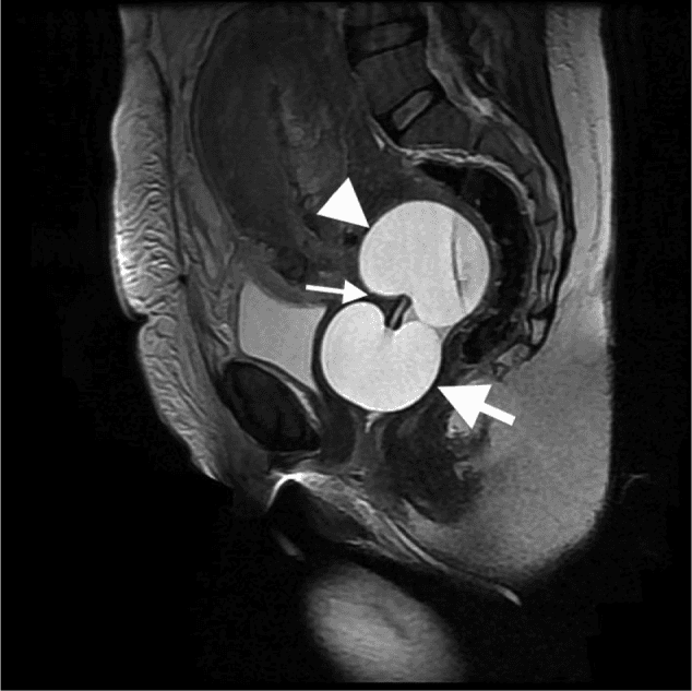 **Modality:** Magnetic Resonance Imaging (MRI)
**Sequence:** Sagittal T2-weighted image
**Anatomical Region:** Female pelvis, specifically focusing on the cervix and vagina.
**Description:**
The image demonstrates a mechanical cervical ripening device in situ. A double-balloon catheter is visible, characterized by two hyperintense (fluid-filled), spherical structures connected by a central catheter.
* **Proximal/Internal Balloon:** Positioned superiorly within the lower uterine segment/internal cervical os, exerting pressure against the internal os (indicated by the arrowhead).
* **Central Catheter:** Transverses the cervical canal (indicated by the thin arrow), showing the mechanical dilation of the cervix.
* **Distal/External Balloon:** Positioned inferiorly within the proximal vagina, abutting the external cervical os (indicated by the thick arrow).
**Clinical Context:**
Findings are consistent with a Cook Cervical Ripening Balloon or similar dual-balloon catheter used for the mechanical induction of labor. The image provides high-contrast visualization of the device's placement relative to pelvic anatomy, confirming correct positioning with the cervix sandwiched between the two inflated balloons. Surroundings show the gravid uterus and adjacent pelvic structures including the bladder and rectum.
