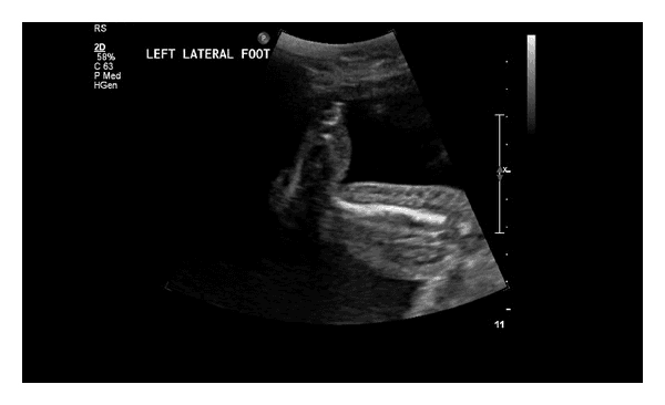 **Imaging Modality:** 2D Greyscale Ultrasound
**Anatomical Region:** Left lateral foot and distal lower extremity.
**Observed Pathology:** Significant subcutaneous soft tissue edema. The image demonstrates a prominent increase in the thickness of the subcutaneous layer along the dorsal and lateral aspects of the foot.
**Characteristic Visual Features:**
* **Cobblestoning Pattern:** There is a diffuse, reticulated hyperechoic appearance of the subcutaneous fat interspersed with anechoic/hypoechoic fluid channels, characteristic of soft tissue edema or cellulitis.
* **Skin Thickening:** The overlying epidermal and dermal layers appear thickened.
* **Fluid Accumulation:** Poorly defined pockets of anechoic fluid are visible within the interstitial spaces, consistent with localized swelling.
* **Anatomical Landmarks:** Cortical surfaces of the underlying tarsal or metatarsal bones are visible as hyperechoic linear structures with posterior acoustic shadowing.
**Key Diagnostic Features:** The presence of the "cobblestone" sign in the subcutaneous tissue is a primary sonographic indicator of inflammatory edema or lymphedema, correlating with the clinical presentation of distal extremity swelling. No discrete abscess or focal fluid collection is visualized in this specific plane.