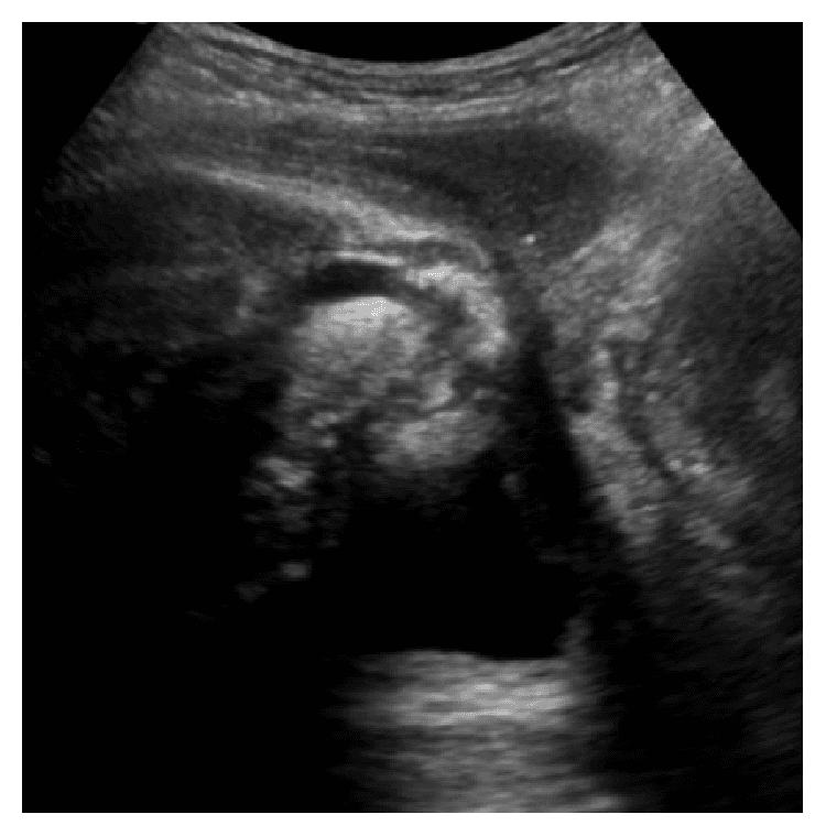 **Modality:** B-mode Ultrasound
**Anatomical Region:** Male perineum, midsagittal plane.
**Description:** This sonographic image visualizes the bulb of the penis (urethral bulb) and surrounding pelvic floor structures in a post-radical prostatectomy state. The ultrasound probe is positioned on the perineal skin (top of the image). Key landmarks include the echogenic urethral bulb located centrally and the anechoic (fluid-filled) urinary bladder situated in the deep field.
**Characteristic Features:**
- The image demonstrates the absence of the prostate gland between the bladder neck and the urethral bulb, consistent with surgical history.
- The orientation shows the ventral aspect to the left and the dorsal aspect to the right.
- The urethral bulb appears as a well-defined, heterogeneous, moderately echogenic structure.
- Distal to the bladder, the surgical site of the vesicourethral anastomosis is visible.
**Clinical Context:** Evaluation of post-prostatectomy anatomy in a patient presenting with stress urinary incontinence to assess the functional positioning and support of the bulbous urethra and pelvic floor muscles.