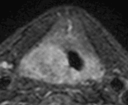 **Imaging Modality:** Magnetic Resonance Imaging (MRI), Axial plane.
**Anatomical Region:** Larynx at the glottic level.
**Observed Pathology:** An asymmetric, intermediate-signal soft tissue mass is localized to the right glottis. The lesion demonstrates significant mass effect, resulting in the medial displacement and narrowing of the laryngeal airway.
**Characteristic Visual Features:**
- **Mass Distribution:** The tumor involves the right vocal cord and extends posteriorly toward the arytenoid region.
- **Invasion Patterns:** There is evidence of posterior extension toward the submucosa of the pyriform sinus and the posterior commissure. The mass involves the area of the posterior cricoarytenoid muscles, suggestive of a T3 stage glottic carcinoma with vocal cord fixation.
- **Signal Intensity:** The lesion appears relatively isointense to slightly hyperintense compared to surrounding musculature on this sequence.
**Diagnostic Differentiating Features:** The critical finding is the posterior and lateral transglottic spread, crossing the midline at the posterior commissure and involving the cricoarytenoid unit, which distinguishes it from localized T1 or T2 glottic lesions. This configuration is consistent with advanced primary laryngeal malignancy requiring detailed assessment of the paraglottic and pre-epiglottic spaces.