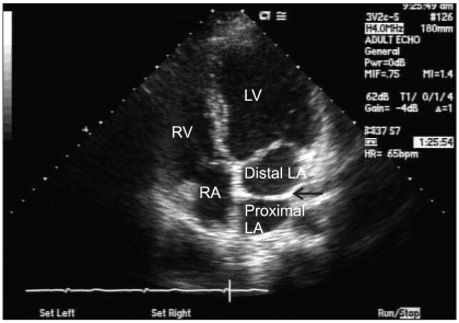 **Imaging Modality:** Transthoracic Echocardiogram (TTE), B-mode ultrasound.
**Anatomical Region:** Apical four-chamber (A4C) view of the heart, showing the left atrium (LA), right atrium (RA), left ventricle (LV), and right ventricle (RV).
**Observed Pathology:** Cor triatriatum sinistrum. A linear, echogenic membrane is visible within the left atrium, bisecting the chamber into two distinct segments.
**Characteristic Visual Features:**
* **Intra-atrial Membrane:** A thin, transverse fibromuscular band (indicated by a black arrow) divides the left atrium into a superior/posterior chamber (proximal LA), which receives the pulmonary veins, and an inferior/anterior chamber (distal LA), which communicates with the mitral valve and left ventricle.
* **Chamber Morphology:** The four cardiac chambers are labeled (LV, RV, RA, LA) to orient the segmental anatomy.
* **Key Diagnostic Finding:** The presence of this accessory membrane within the left atrium is the pathognomonic feature of Cor triatriatum sinistrum, distinguishing it from other supravalvular structures or mitral valve pathologies.
**Clinical Context:** This finding is a rare congenital cardiac anomaly that can mimic mitral stenosis due to the potential obstruction of blood flow between the proximal and distal left atrial segments.
