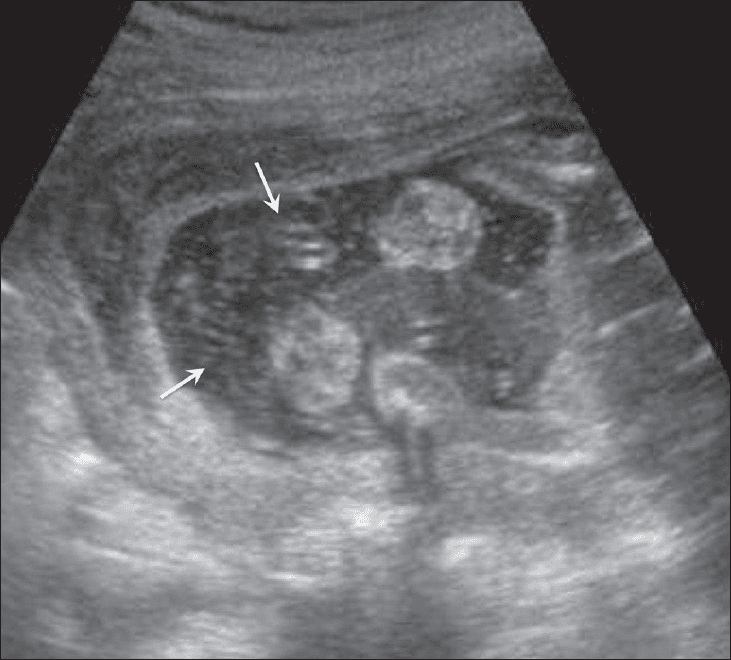 **Imaging Modality:** Obstetric Ultrasound (Gray-scale)
**Anatomical Region:** Intrauterine environment, specifically the amniotic cavity.
**Observed Pathology/Features:** The image demonstrates numerous fine, punctate, and linear hyperechoic particles (particulate matter) suspended within the normally anechoic (black) amniotic fluid. These floating internal echoes (indicated by white arrows) represent debris within the gestational sac. Surrounding fetal parts are visible but lack sharp definition due to the presence of the suspended material.
**Characteristic Visual Features:** The distribution of the echoes is diffuse and heterogeneous, creating a "snowstorm" or turbid appearance within the fluid. There is no evidence of significant shadowing, suggesting a soft-tissue or cellular composition rather than calcification.
**Clinical Context & Differentiation:** In this clinical presentation, the echogenic amniotic fluid is associated with fetal skin desquamation. Differential considerations for echogenic amniotic fluid typically include vernix caseosa (especially in the third trimester), intra-amniotic hemorrhage, or meconium staining. The specific postnatal diagnosis in this case is aplasia cutis congenita, where the echoes reflect sloughed cutaneous material.