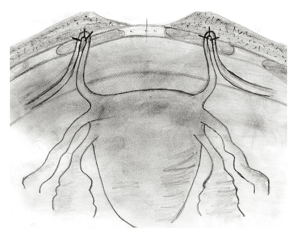 **Imaging Modality:** Medical schematic illustration (pencil/grayscale sketch).
**Anatomical Region:** Female pelvic anatomy focusing on the uterus, adnexa, and anterior abdominal wall.
**Observed Procedure/Landmarks:**
The illustration depicts a surgical uterine suspension procedure. Key anatomical structures include the uterine fundus, fallopian tubes, and the round ligaments of the uterus. The round ligaments are shown extending bilaterally from the uterine cornua.
**Characteristic Visual Features:**
The schematic highlights the bilateral fixation of the round ligaments to the rectus fascia of the anterior abdominal wall. The distal portions of the round ligaments are looped through or anchored to the fascial layer, secured with visible sutures. This anatomical arrangement demonstrates the shortening or plication of the ligaments to provide superior and anterior support to the uterus.
**Clinical Context:**
This visual represents a surgical technique for the correction of uterine retroversion or pelvic organ prolapse. The procedure aims to reposition the uterus into an anteverted state by utilizing the native support of the round ligaments and anchoring them to the sturdy fascial layers of the abdominal wall.
