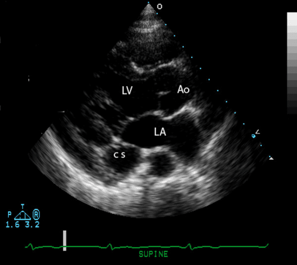 **Modality:** Transthoracic Echocardiogram (TTE).
**View:** Parasternal Long-Axis (PLAX) view.
**Anatomical Landmarks:** The image displays the left ventricle (LV), left atrium (LA), and the aortic root (Ao). The descending thoracic aorta is partially visible in the far field.
**Observed Pathology:** There is a prominent, dilated coronary sinus (CS) visualized in cross-section within the atrioventricular groove, posterior to the left atrium and anterior to the descending aorta.
**Visual Features:** The coronary sinus appears as a distinct, enlarged circular anechoic structure. The surrounding cardiac chambers (LV, LA, Ao) maintain their relative anatomical positions. An electrocardiogram (ECG) lead trace is visible at the bottom of the frame, indicating the timing within the cardiac cycle.
**Clinical Context/Differentiating Features:** A dilated coronary sinus is a characteristic finding often associated with increased right atrial pressure or persistent left superior vena cava (PLSVC). This image serves as a diagnostic reference for identifying venous anomalies or volume/pressure overload in the right heart system via standard parasternal imaging.