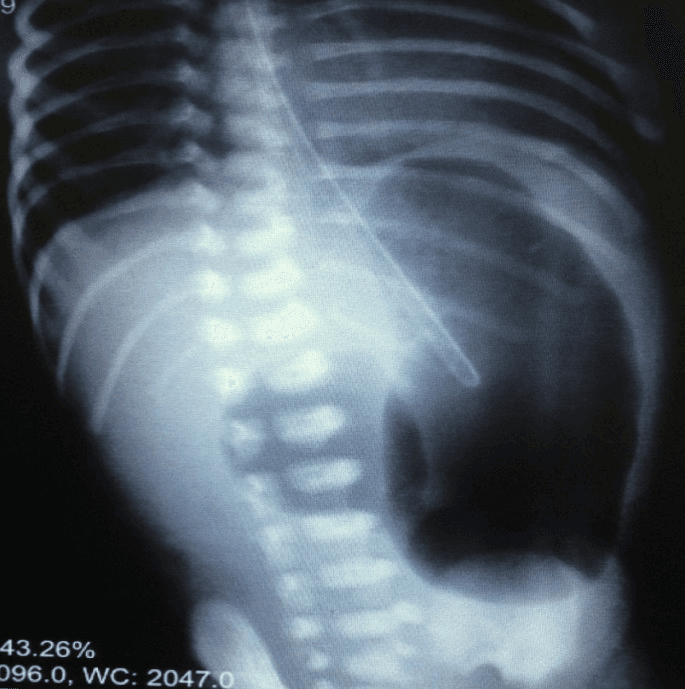 **Imaging Modality:** Plain abdominal radiograph (X-ray), anteroposterior (AP) view.
**Anatomical Region:** Neonatal/pediatric abdomen and lower thorax.
**Observed Pathology:** The image demonstrates the classic "double bubble" sign, highly suggestive of proximal intestinal obstruction, most commonly associated with duodenal atresia.
**Characteristic Visual Features:**
- **Double Bubble Sign:** Two prominent, air-filled, dilated structures are visible in the upper abdomen. The larger lucency on the left represents the dilated stomach, while the smaller lucency to the right of the midline represents the dilated proximal duodenum.
- **Gas Distribution:** There is a complete absence of distal bowel gas (gasless abdomen) beyond the second "bubble," indicating a high-grade or complete obstruction.
- **Supportive Structures:** An enteric (nasogastric/orogastric) tube is visible, with its distal tip positioned within the gastric lucency.
- **Skeletal Landmarks:** The visible ribs and vertebral bodies show immature ossification centers consistent with a neonate.
**Key Diagnostic Features:** The simultaneous dilation of the stomach and proximal duodenum with an absence of distal intestinal air is the pathognomonic radiographic hallmark of duodenal atresia, stenosis, or annular pancreas in a newborn.