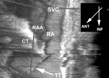 **Imaging Modality:** Three-dimensional (3D) grayscale anatomical reconstruction derived from a volumetric data-set.
**Anatomical Region:** Internal view of the right atrium (RA) of the heart, focusing on the sub-eustachian and septal regions.
**Key Landmarks & Structural Features:**
- **Superior Vena Cava (SVC):** Positioned superiorly, marking the venous inflow.
- **Right Atrial Appendage (RAA):** Visible as a muscular pouch.
- **Crista Terminalis (CT):** A prominent muscular ridge separating the smooth sinus venarum from the pectinate muscles.
- **Tendon of Todaro (TT):** Labeled and indicated by an arrow, this fibrous structure runs from the Eustachian valve toward the central fibrous body. It forms the superior border of the Triangle of Koch.
**Visual Findings:**
The reconstruction displays the spatial orientation of the right atrial endocardial surface. An orientation inset indicates the anterior (ANT) and inferior (INF) axes. The Tendon of Todaro is visualized as a discrete linear band, essential for identifying the Triangle of Koch—a critical surgical and electrophysiological landmark containing the atrioventricular (AV) node.
**Diagnostic Significance:**
This anatomical mapping is used to localize the AV node and conduct cardiac mapping for ablation procedures.