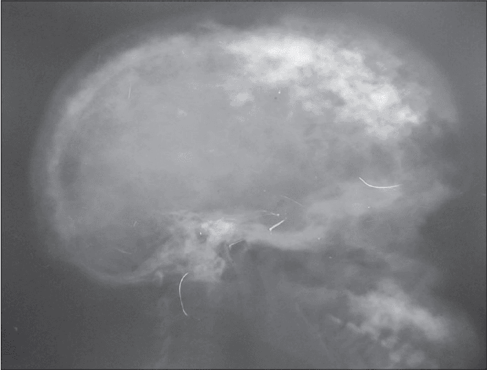 **Imaging Modality:** Lateral plain film radiograph (X-ray).
**Anatomical Region:** Skull (cranium).
**Observed Pathology:** Advanced Paget's disease of bone (osteitis deformans).
**Characteristic Visual Features:**
The image demonstrates a classic "cotton wool appearance" characterized by multifocal, ill-defined sclerotic patches interspersed with radiolucent areas throughout the calvarium. There is marked thickening of the diploic space and expansion of the outer table of the skull. The normal cortical margins of the inner and outer tables are blurred due to disorganized bone remodeling.
**Key Diagnostic Features:**
- **Cotton wool spots:** Focal areas of opacification representing the sclerotic phase of Paget's disease.
- **Diploic thickening:** Significant widening of the cranial vault.
- **Bone expansion:** Generalized enlargement of the skull landmarks compared to normal anatomical proportions.
**Clinical Significance:** These radiographic findings are pathognomonic for the mixed lytic and sclerotic stages of Paget’s disease involving the axial skeleton, specifically the calvarium.