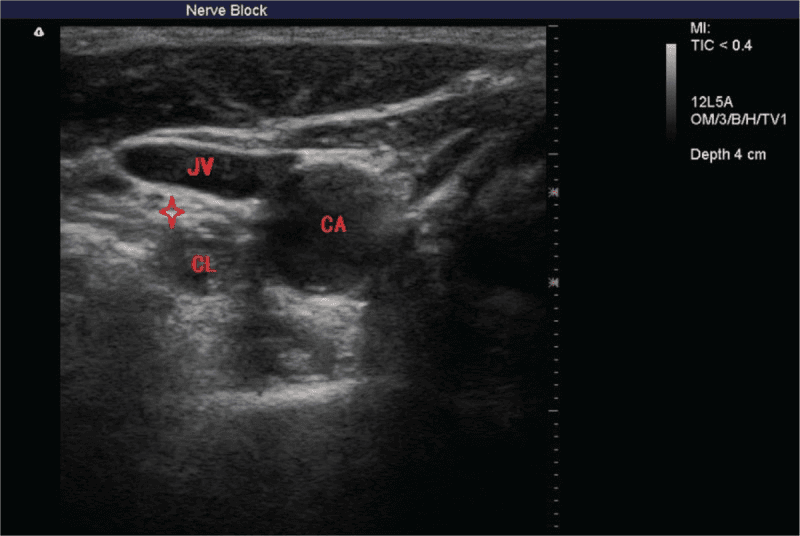**Imaging Modality:** Ultrasound (B-mode ultrasonography)
**Anatomical Region:** Cervical spine region (C6–C7 level), transverse view.
**Key Landmarks and Findings:**
The image displays the anatomical landmarks relevant for a stellate ganglion nerve block. Key vascular structures include the anechoic, pulsatile common carotid artery (CA) and the partially compressible internal jugular vein (JV). Deep to the prevertebral fascia, the longus colli muscle (CL) is visible as a hypoechoic structure situated anterior to the transverse process.
The stellate ganglion (cervicothoracic ganglion) is identified as a small, oval, hypoechoic neural structure, marked with a red star, located medial to the carotid artery and superficial to the longus colli muscle. The image demonstrates the relationship between the sympathetic chain and the overlying prevertebral fascia, providing a target for ultrasound-guided regional anesthesia.
**Clinical Context:**
This ultrasonogram is utilized for procedural guidance in a nerve block, specifically to ensure precise needle placement and to avoid accidental puncture of adjacent vascular structures such as the carotid artery or vertebral artery.