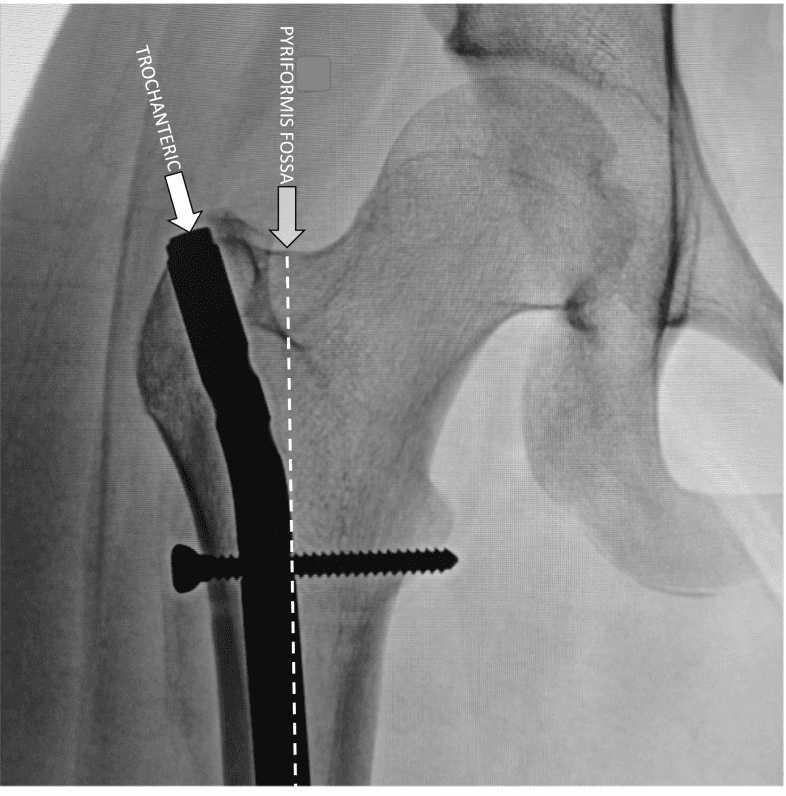 **Imaging Modality:** Fluoroscopic Anteroposterior (AP) radiograph.
**Anatomical Region:** Proximal femur and hip joint.
**Observed Device/Pathology:** Antegrade intramedullary femoral nail (cephalomedullary nail) in situ. The image highlights the surgical entry point of the hardware relative to the proximal femoral anatomy.
**Characteristic Visual Features:**
* **Hardware:** A radiopaque intramedullary rod is positioned within the femoral canal. A transverse interlocking lag screw is visible, extending through the rod toward the femoral neck/head.
* **Entry Point:** An arrow labeled "TROCHANTERIC" points to the proximal tip of the nail, demonstrating its insertion through the tip of the greater trochanter.
* **Anatomical Landmark Comparison:** A second arrow and a vertical dashed line labeled "PYRIFORMIS FOSSA" indicate the traditional entry point medial to the greater trochanter.
* **Nail Geometry:** The rod exhibits a lateral proximal bend (valgus offset) designed to accommodate the trochanteric entry point.
**Clinical Context:** This image demonstrates the positioning of a trochanteric-entry nail, a design intended to preserve the medial soft tissues and vascularity associated with the piriformis fossa and femoral neck.