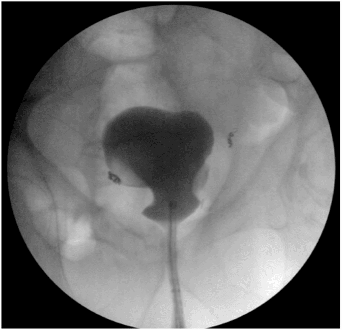 **Imaging Modality:** Intraoperative fluoroscopic cystogram (retrograde cystography).
**Anatomical Region:** Lower abdomen and pelvis, specifically the lower urinary tract.
**Observed Anatomy and Findings:**
The image demonstrates a contrast-filled urinary bladder and urethra. The bladder exhibits a normal anatomical globular morphology and midline position within the bony pelvis. There is clear luminal continuity between the urethra and the bladder neck, indicating a patent urethral tract. Contrast opacification is uniform without evidence of extravasation, filling defects, or gross wall irregularities.
**Characteristic Visual Features:**
- **Contrast Distribution:** Dense opacification of the bladder and the narrow, linear passage of the urethra.
- **Surgical Hardware:** Small, radiopaque surgical clips or coils are visible in the bilateral pelvic regions, lateral to the bladder, consistent with recent surgical intervention.
- **Bony Landmarks:** The pelvic girdle, including the pubic symphysis and iliac wings, provides anatomical orientation.
**Clinical Context:**
The study confirms post-surgical integrity of the vesicourethral junction and the absence of obstructive uropathy or anastomotic leaks. This is a characteristic appearance of a successful urethral reconstruction or bladder repositioning procedure.