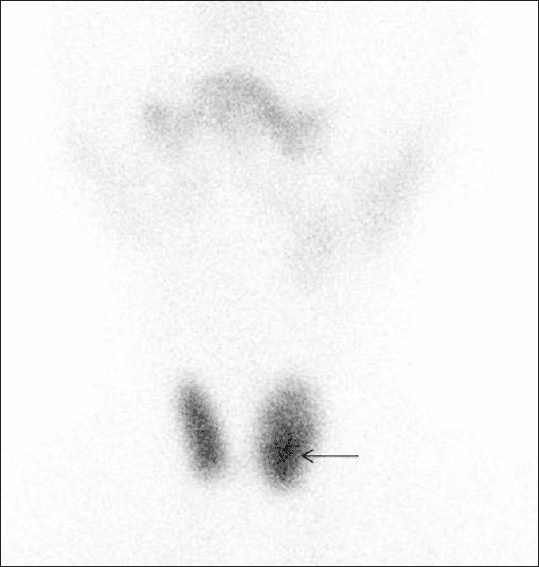 **Imaging Modality:** Technetium-99m (Tc-99m) pertechnetate thyroid scintigraphy.
**Anatomical Region:** Anterior view of the neck and upper thorax, visualizing the thyroid gland and salivary glands (submandibular and parotid glands).
**Observed Pathology:** The scan reveals a hyperfunctioning ("hot") nodule located in the lower pole of the left thyroid lobe (indicated by an arrow). This area demonstrates focal, intense radiotracer uptake compared to the surrounding thyroid parenchyma.
**Characteristic Visual Features:**
* **Hypermetabolic Activity:** Increased tracer concentration in the left lower pole, characteristic of an autonomous or hyperfunctioning follicular lesion.
* **Tracer Distribution:** Normal physiological uptake is visible in the salivary glands and the right thyroid lobe.
* **Nodule Morphology:** The hot nodule appears somewhat ill-defined and occupies a significant portion of the left lobe's inferior aspect.
**Clinical Significance:** A solitary "hot" nodule on Tc-99m scintigraphy typically suggests a benign etiology, such as a toxic adenoma or a hyperfunctioning follicular adenoma. The presence of focal radiopharmaceutical accumulation helps differentiate this from a "cold" nodule, which carries a higher risk of malignancy.