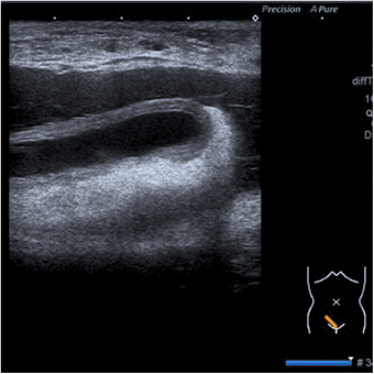 **Imaging Modality:** Ultrasound (Grayscale B-mode sonography).
**Anatomical Region:** Right lower quadrant (RLQ) of the abdomen.
**Observed Pathology:** Acute appendicitis.
**Characteristic Visual Features:**
The image displays a longitudinal view of a blind-ending, tubular structure in the right iliac fossa, consistent with the vermiform appendix. Key sonographic findings include:
* **Increased Caliber:** Significant thickening and distension of the appendiceal diameter.
* **Wall Thickening:** Distinct mural thickening with preservation of gut signatures (hypoechoic and hyperechoic layers).
* **Luminal Distension:** The lumen appears fluid-filled and non-compressible.
* **Periappendiceal Changes:** There is a surrounding zone of increased echogenicity in the adjacent mesenteric fat, indicative of inflammatory fat secondary to the infection.
**Diagnostic Features:** The combination of a non-compressible, blind-ending tubular structure exceeding 6mm in diameter with surrounding hyperechoic inflammatory fat is highly diagnostic of acute appendicitis. The orientation and anatomical marker on the UI confirm the probe placement over the McBurney's point region.