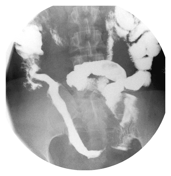 **Imaging Modality:** Fluoroscopic barium small bowel follow-through (radiogram).
**Anatomical Region:** Lower abdomen and pelvis, specifically the distal small intestine and terminal ileum.
**Observed Pathology:** Segmental mural thickening and mass effect involving a significant portion of the distal small bowel/terminal ileum. The affected loop demonstrates significant separation and displacement from adjacent intestinal segments, suggesting transmural inflammation or mesenteric thickening.
**Characteristic Visual Features:**
- **Contrast Distribution:** Positive oral contrast (barium) opacifies the lumen of several small bowel loops.
- **Mural Appearance:** There is a notable "string-sign-like" appearance or narrowing of the terminal ileum leading to the cecum, though the mucosal surface remains relatively smooth without overt ulceration or cobblestoning in this view.
- **Spatial Arrangement:** A long segment of the distal ileum is isolated from surrounding loops, a radiologic indicator of significant bowel wall thickening or fibrofatty proliferation (creeping fat) often associated with chronic inflammatory processes.
- **Negative Findings:** Absence of pneumoperitoneum, high-grade mechanical obstruction, or extraluminal contrast extravasation.
**Clinical Context:** Radiologic features are consistent with the terminal ileal involvement of Crohn’s disease, characterized by bowel wall thickening and mesenteric separation.