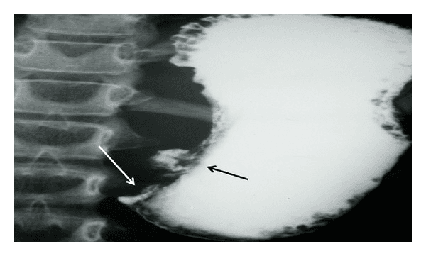 **Imaging Modality:** Barium meal (upper gastrointestinal fluoroscopy with oral contrast).
**Anatomical Region:** Distal stomach, specifically the antrum and pyloric region.
**Observed Pathology:** The image demonstrates a significant gastric outlet obstruction. A prominent barium-filled collection, characteristic of an ulcer crater, is visible along the lesser curvature of the stomach (indicated by the black arrow). Distal to this, there is a marked narrowing and abrupt termination of the contrast column at the pylorus (indicated by the white arrow), suggesting luminal obstruction.
**Characteristic Visual Features:**
* **Ulcer Niche:** An out-pouching of contrast material representing a localized mucosal defect or crater.
* **Luminal Narrowing:** Severe attenuation of the gastric lumen in the prepyloric region.
* **Contrast Retention:** Significant pooling of barium within a dilated gastric body and antrum, with minimal to no contrast passing into the duodenum.
**Clinical Significance:** These findings are highly suggestive of chronic peptic ulcer disease leading to cicatricial pyloric stenosis or acute inflammatory edema resulting in gastric outlet obstruction. This description is optimized for retrieval in databases concerning gastrointestinal radiology and obstructive gastric pathologies.