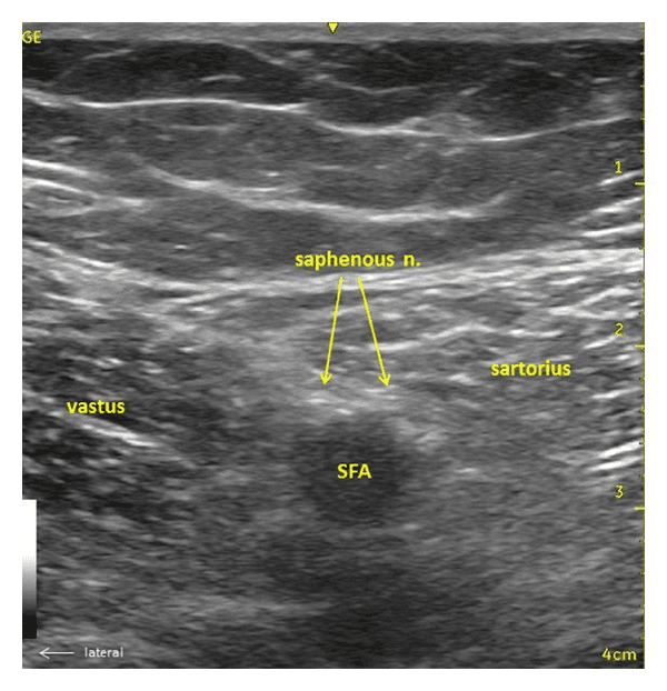 **Imaging Modality:** B-mode Ultrasound (Sonoanatomy)
**Anatomical Region:** Mid-thigh, transverse cross-section at the level of the adductor canal.
**Key Landmarks and Structures:**
* **Musculature:** The sartorius muscle is visible medially/superficially, and the vastus medialis is situated laterally.
* **Vasculature:** The superficial femoral artery (SFA) appears as a prominent, anechoic circular structure deep to the sartorius muscle.
* **Neural Structures:** The saphenous nerve is identified as small, hyperechoic, honeycomb-patterned fascicles located anterolateral to the SFA, deep to the sartorius muscle, and superficial to the adductor canal.
**Visual Features:** The image demonstrates the characteristic fascial planes separating the anterior and medial thigh compartments. The saphenous nerve is highlighted with yellow arrows, showcasing its position relative to the pulsatile artery and the overlying sartorius muscle.
**Clinical Context:** This view is essential for ultrasound-guided regional anesthesia, specifically for performing an adductor canal block to provide sensory blockade of the saphenous nerve for distal knee and foot surgery.