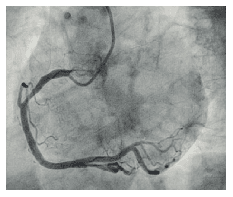 **Imaging Modality:** Invasive coronary angiography (fluoroscopy).
**Anatomical Region:** Coronary arterial circulation, specifically the right coronary artery (RCA) visualized in a Left Anterior Oblique (LAO) projection.
**Observed Pathology/Anatomy:** This image demonstrates a "super-dominant" right coronary artery. The vessel exhibits significant caliber and extensive distribution, originating from the right coronary sinus.
**Characteristic Visual Features:**
* **Course:** The RCA traverses the right atrioventricular groove, extending past the crux of the heart.
* **Territory:** The vessel provides not only the posterior descending artery (PDA) and posterior left ventricular (PLV) branches but also extends further to supply a large portion of the lateral and postero-lateral walls of the left ventricle.
* **Vessel Morphology:** The RCA appears large-caliber and tortuous, showing no significant stenotic lesions in the visible segments.
**Key Diagnostic Features:** The diagnostic hallmark is the unusual extension of the RCA beyond the crux, crossing the diaphragmatic surface to supply territories typically served by the left circumflex (LCx) artery. This anatomical variant represents an extreme form of right-sided coronary dominance.
