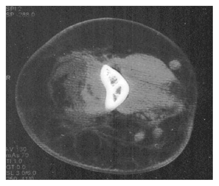 **Imaging Modality:** Computed Tomography (CT) scan, axial cross-section.
**Anatomical Region:** Upper extremity, specifically the mid-shaft region of the arm (humerus).
**Observed Pathology:** Extensive soft tissue inflammatory process characterized by a large, poorly circumscribed fluidic collection within the deep compartments. There is significant heterogeneous rearrangement and increased attenuation of the subcutaneous and intermuscular fatty tissue, consistent with fat stranding and cellulitis.
**Characteristic Visual Features:**
* **Muscular Involvement:** Evidence of muscular necrosis and edema, visualized as loss of normal myofascial architecture and low-attenuation areas within the muscle bellies.
* **Fascial Changes:** Marked thickening of the intermuscular septa and deep fascia.
* **Fluid Collection:** A localized, hypodense fluid accumulation suggestive of abscess formation or necrotizing infection.
* **Bony Landmark:** The humerus is centrally located with a preserved cortical outline, though surrounding soft tissue changes are severe.
**Diagnostic Features:** The combination of diffuse fat stranding, thickened septa, and muscular breakdown is highly suggestive of a severe necrotizing soft tissue infection (NSTI) or phlegmonous transformation. Neutral bone appearance helps differentiate primarily soft-tissue pathology from primary osteomyelitis with secondary extension.