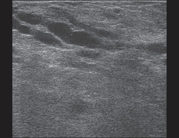**Imaging Modality:** B-mode grayscale ultrasound.
**Anatomical Region:** Female breast tissue.
**Observed Findings:**
* **Parenchyma:** The breast tissue demonstrates a diffusely hyperechoic and heterogeneous echo texture, characteristic of physiologic changes in the lactating breast (lactational adenosis).
* **Ductal Structures:** Multiple dilated, prominent, and branching tubular structures are visible in the subareolar and mid-parenchymal regions. These represent dilated lactiferous ducts.
* **Internal Echoes:** The dilated ducts contain anechoic to low-level internal echoes, consistent with the accumulation of milk or colostrum.
* **Tissue Architecture:** There is increased vascularity and glandular prominence with a decrease in visible subcutaneous and retromammary fat, reflecting the functional state of lactation.
**Diagnostic Features:** Diffuse hyperechogenicity of the glandular elements combined with prominent ductal dilatation (ductectasia) in a clinical context of lactation. No discrete solid masses or suspicious architectural distortions are visualized in this section.
**Clinical Significance:** This appearance is a normal physiologic variation of the breast during pregnancy and the postpartum period.