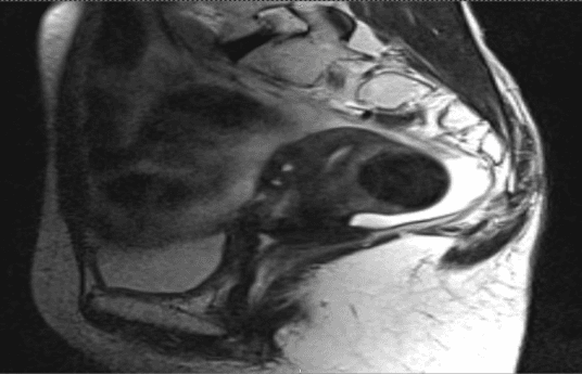 **Imaging Modality:** Magnetic Resonance Imaging (MRI), T2-weighted sequence.
**Anatomical Region:** Sagittal view of the female pelvis.
**Key Landmarks:** Visible structures include the sacrum and coccyx posteriorly, the pubic symphysis anteriorly, the urinary bladder, and the rectum.
**Observed Findings:**
- **Uterine Orientation:** The uterus is clearly visualized in a retroverted and retroflexed position, with the fundus directed posteriorly toward the sacrum.
- **Uterine Morphology:** The zonal anatomy of the uterus (endometrium, junctional zone, and myometrium) is discernible. The cervical region and vaginal vault are visible inferior to the uterine body.
- **Adjacent Organs:** The urinary bladder is situated anteriorly, appearing partially decompressed. The rectum is located posterior to the retroverted uterus.
- **Pathology/Context:** The image displays the pelvic anatomy post-external beam radiotherapy (EBRT). There is no gross evidence of large exophytic masses, though the retroverted positioning is a key anatomical variant relevant for brachytherapy planning and treatment monitoring.
**Diagnostic Features:** The sagittal plane highlights the posterior angulation of the uterine long axis relative to the vaginal axis, confirming retroversion. Signal intensities are consistent with post-treatment tissue characteristics in a T2-weighted acquisition.