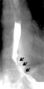 **Imaging Modality:** Fluoroscopic contrast study (Barium Swallow/Esophagram).
**Anatomical Region:** Lower esophagus and gastroesophageal junction.
**Observed Pathology:** There is a significant, high-grade irregular narrowing involving the distal segment of the esophagus. The lesion demonstrates asymmetric mucosal irregularities and abrupt luminal tapering, characteristic of a malignant stricture.
**Characteristic Visual Features:**
- **Apple-core configuration:** The circumferential narrowing displays "shouldering" at the proximal margin where the normal esophageal lumen meets the stenotic segment.
- **Proximal Dilation:** Mild pre-stenotic dilation is visible superior to the narrowing, indicating chronic partial obstruction.
- **Mucosal Pattern:** The contrast column within the narrowed segment appears jagged and thread-like (rat-tail appearance), suggesting infiltrative mucosal destruction rather than a smooth, benign process.
**Diagnostic Significance:** These features are highly suggestive of primary esophageal neoplasia (e.g., adenocarcinoma or squamous cell carcinoma) or secondary malignant infiltration. The image provides critical visual evidence for differentiating malignant strictures from benign esophageal webs, rings, or peptic strictures based on the irregularity and shouldered margins.