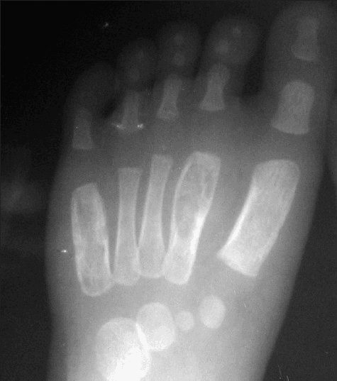 **Imaging Modality:** Anteroposterior (AP) projection radiograph (X-ray).
**Anatomical Region:** Left pediatric foot, including the metatarsals, phalanges, and tarsal bones.
**Observed Pathology:** The image demonstrates significant fusiform, expansile remodeling of the diaphyses of the second and fifth metatarsals. These lesions exhibit cortical thinning and a "wind-filled" appearance, characteristic of tuberculous dactylitis, also known as spina ventosa.
**Characteristic Visual Features:**
* **Expansile Bone Destruction:** Marked expansion of the medullary cavity in the affected metatarsals.
* **Cortical Changes:** Prominent thinning of the overlying cortex without an aggressive periosteal reaction.
* **Skeletal Maturity:** Presence of open growth plates and primary ossification centers consistent with a pediatric patient.
* **Distribution:** Multiple, non-contiguous involvement of the small tubular bones of the foot.
**Key Diagnostic Features:** The combination of cystic-like expansion of short tubular bones and cortical thinning in a pediatric patient is highly suggestive of osseous tuberculosis (spina ventosa), distinguishing it from other lytic bone lesions or dactylitis caused by sickle cell disease or syphilis.