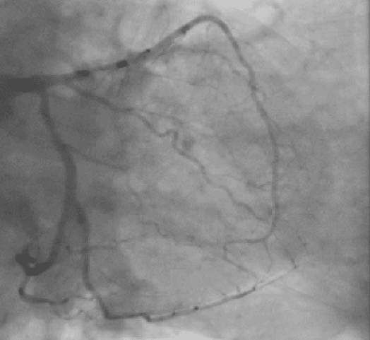 **Imaging Modality:** Invasive Coronary Angiography (ICA); Fluoroscopy.
**Anatomical Region:** Left Coronary Artery (LCA) system.
**Observed Anatomy & Pathology:** This fluoroscopic image demonstrates the left coronary circulation in a projection showing the Left Main Coronary Artery (LMCA) bifurcating into the Left Anterior Descending (LAD) and the Left Circumflex (LCx) arteries. The LCx appears prominent and elongated, extending into the territory typically occupied by the Right Coronary Artery.
**Characteristic Visual Features:**
* **Coronary Dominance:** Visual evidence of left dominance, characterized by the LCx artery supplying the posterior descending artery (PDA) and the posterolateral branches.
* **Vessel Morphology:** The LAD follows the anterior interventricular groove, giving off diagonal branches. The LCx travels within the atrioventricular groove, exhibiting a large distal extension toward the inferior wall of the heart.
* **Contrast Opacification:** Homogeneous opacification of the arterial tree is visible, allowing for the assessment of luminal patency.
**Key Diagnostic Features:** Identification of left coronary dominance is established by the LCx crossing the crux of the heart to provide the primary blood supply to the inferior diaphragmatic surface. This anatomical variant is a critical finding for percutaneous coronary intervention (PCI) planning and surgical revascularization.