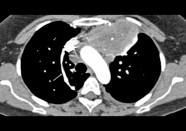 **Imaging Modality:** Contrast-enhanced computed tomography (CT) of the chest, axial section.
**Anatomical Region:** Mediastinum at the level of the aortic arch and superior vena cava (SVC).
**Observed Pathology:** A large, heterogeneous, mildly enhancing soft-tissue mass is centered in the anterior mediastinum. The mass demonstrates irregular borders and exerts a mass effect on adjacent vascular structures. Based on clinical context, this is consistent with a mediastinal germ cell tumor.
**Characteristic Visual Features:**
* **Mass:** The lesion (marked with an asterisk) occupies the prevascular space, displacing the mediastinal pleura laterally.
* **Vascular Anatomy:** The superior vena cava and aortic arch are visible. A prominent, linear vascular structure (marked with an arrow) is identified as the azygos vein, seen here in a longitudinal plane as it courses anteriorly to drain into the posterior aspect of the SVC.
* **Attenuation:** The mass shows internal areas of varying attenuation, suggesting a complex solid component.
**Key Diagnostic Features:** The location in the anterior mediastinum (one of the "4Ts": Thymoma, Teratoma/Germ cell tumor, Thyroid, Terrible Lymphoma) and the patient's age are primary indicators for the differential diagnosis. The image highlights the relationship between the anterior mass and the normal posterior vascular anatomy, specifically the azygos vein arch.
