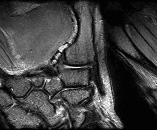 **Modality:** Magnetic Resonance Imaging (MRI), T1-weighted sequence.
**Anatomical Region:** Coronal view of the thumb carpometacarpal (CMC) joint, also known as the trapeziometacarpal joint.
**Key Landmarks:** The image clearly delineates the articulation between the distal surface of the trapezium and the proximal base of the first metacarpal. Adjacent carpal bones, including the scaphoid and trapezoid, are visible in the proximal and medial fields.
**Visual Features:**
- **Osseous Structures:** The saddle-shaped morphology of the trapeziometacarpal joint is visualized. Cortical margins appear sharp with high-signal subchondral bone.
- **Joint Space:** The articular gap is well-defined, showing the relationship between the reciprocal concave and convex surfaces of the joint.
- **Soft Tissues:** Intermediate signal intensity represents the surrounding capsular ligaments and intrinsic musculature of the thenar eminence.
- **Texture:** The image demonstrates high-resolution trabecular patterns within the cancellous bone, characteristic of ex vivo cadaveric imaging.
**Clinical Significance:** This high-detail anatomical study is utilized for evaluating joint congruivity, detecting subchondral changes, and assessing ligamentous integrity in the context of osteoarthritis or mechanical instability of the first ray.