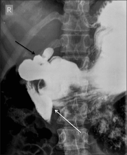 **Imaging Modality:** Fluoroscopic barium meal study, supine view.
**Anatomical Region:** Upper gastrointestinal tract, specifically the stomach and duodenum.
**Observed Pathology and Visual Features:**
- **Duodenal Obstruction:** A distinct, linear vertical filling defect is visible across the proximal third (D3 segment) of the duodenum. This extrinsic compression results in significant pre-stenotic dilatation of the second part (D2 segment) of the duodenum, characteristic of Superior Mesenteric Artery (SMA) syndrome.
- **Duodenal Bulb Deformity:** A "trifoliate" or "clover-leaf" deformity of the duodenal bulb is present. This morphology is characterized by central narrowing with multiple surrounding pseudodiverticula or sacculations.
**Key Diagnostic Features:**
- The vertical indentation on the transverse duodenum suggests extrinsic vascular compression.
- The clover-leaf deformity is a pathognomonic radiologic sign of a chronic, healed duodenal ulcer with secondary scarring and retraction of the bulb.
**Clinical Significance:** The image demonstrates dual pathology: mechanical duodenal obstruction consistent with SMA syndrome and structural remodeling from prior peptic ulcer disease.