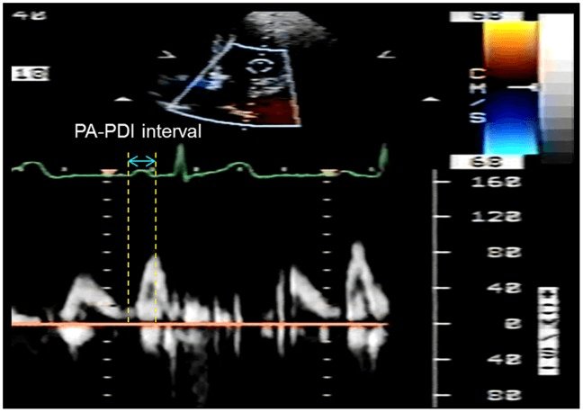 **Imaging Modality:** Transthoracic echocardiogram (TTE) utilizing Pulse-Wave (PW) Doppler imaging synchronized with a simultaneous electrocardiogram (ECG) tracing.
**Anatomical Region:** Apical four-chamber view focusing on the mitral valve inflow tract.
**Observed Findings:** The image displays a dual-mode display with a color Doppler sector at the top and a PW Doppler spectral tracing at the bottom. The spectral tracing shows the characteristic biphasic mitral inflow pattern, consisting of the early diastolic (E wave) and late diastolic (A wave) peaks. A concurrent ECG tracing (Lead II) is visible above the spectral waveform.
**Measurements and Markers:** The "PA-PDI interval" is annotated, representing the atrial electromechanical delay. Vertical calipers mark the duration from the onset of the P-wave on the ECG to the peak of the mitral A-wave on the PW Doppler tracing.
**Diagnostic Context:** This measurement is used to evaluate atrial mechanical function and electromechanical coupling. It is a key parameter in assessing atrial remodeling and predicting the risk of atrial arrhythmias, such as atrial fibrillation. The velocity scale on the right indicates flow measurements in cm/s.