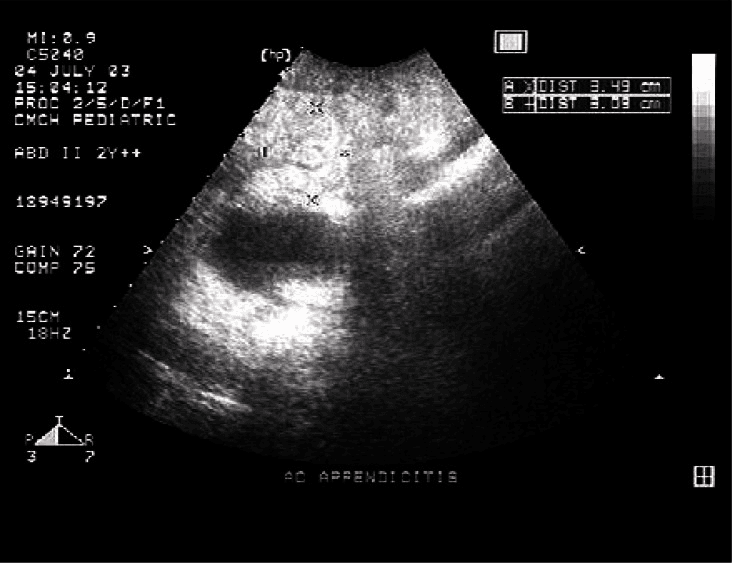 **Imaging Modality:** Abdominal Ultrasound (Greyscale sonography).
**Anatomical Region:** Right lower quadrant of the abdomen.
**Observed Pathology:** Acute appendicitis.
**Characteristic Visual Features:**
- **Transverse View:** The image displays a cross-sectional ("target" or "bullseye") appearance of the appendix.
- **Morphology:** There is a non-compressible, blind-ending tubular structure with an enlarged outer diameter measuring 11 mm (exceeding the standard diagnostic threshold of 6–7 mm).
- **Wall Features:** Circumferential wall thickening is visible with a central hypoechoic lumen.
- **Extra-appendiceal Findings:** Prominent hyperechoic (echogenic) periappendiceal fat is observed surrounding the structure, indicative of secondary inflammatory changes (fat stranding).
- **Secondary Cues:** On-screen calipers provide measurement verification of the distended structure.
**Key Diagnostic Features:** Dilated appendix (>6 mm) in the transverse plane combined with increased echogenicity of the surrounding mesenteric fat, classic sonographic hallmarks of acute inflammation.