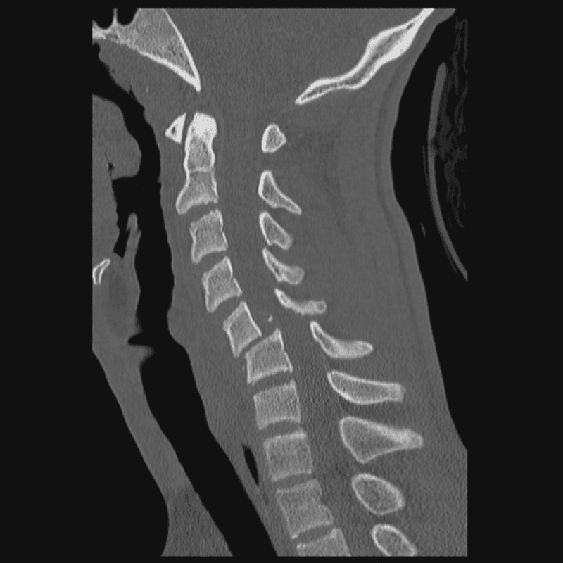 **Imaging Modality:** Computed Tomography (CT), sagittal reformatted view.
**Anatomical Region:** Cervical spine extending from the craniocervical junction to the upper thoracic levels.
**Observed Pathology:** Traumatic cervical spine injury characterized by a high-grade anterolisthesis of C5 on C6. There is a complete disruption of the normal spinolaminar line and posterior vertebral line, consistent with a bilateral facet dislocation or severe fracture-subluxation.
**Characteristic Visual Features:**
- **Skeletal Alignment:** Significant anterior displacement of the C5 vertebral body relative to C6, resulting in "off-set" alignment.
- **Canal Dimensions:** Severe narrowing and compromise of the central spinal canal diameter at the C5-C6 level due to the osseous translation.
- **Associated Findings:** Disruption of the anterior and posterior longitudinal ligament planes; prevertebral soft tissue swelling is suggested anterior to the mid-cervical vertebrae. The remaining cervical segments (C1-C4 and C7) appear relatively aligned.
**Key Diagnostic Features:** Traumatic spondylolisthesis with acute spinal canal stenosis, secondary to a distractive-flexion injury mechanism. This represents a highly unstable cervical spine fracture-dislocation pattern.