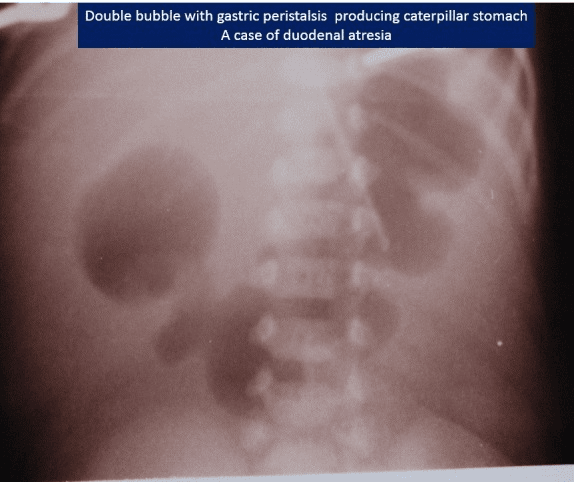 **Imaging Modality:** Plain abdominal radiograph (X-ray), supine view.
**Anatomical Region:** Upper abdomen.
**Observed Pathology:** Duodenal atresia.
**Characteristic Visual Features:**
The image demonstrates the classic "double bubble" sign, characterized by two prominent, air-filled radiolucencies in the upper abdomen. One bubble represents the dilated stomach (left), and the second represents the dilated proximal duodenum (right). A hallmark "caterpillar sign" is visible, where the gastric contour exhibits multiple undulations or hyperperistaltic waves against the obstruction, resembling the body of a caterpillar. There is a complete absence of distal bowel gas, indicating a high-grade or total intestinal obstruction.
**Key Diagnostic Features:**
- **Double Bubble Sign:** Diagnostic of proximal duodenal obstruction.
- **Caterpillar Sign:** Indicates active gastric peristalsis attempting to overcome the distal duodenal atresia.
- **Gasless Distal Abdomen:** Confirms the complete nature of the atresia, distinguishing it from partial stenosis or malrotation where some distal gas may be present.
**Clinical Context:** This presentation is pathognomonic for congenital duodenal atresia in a neonatal patient.