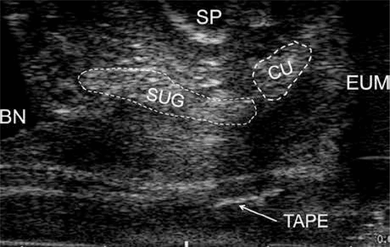 **Imaging Modality:** Transvaginal ultrasound (biplane electronic probe, linear array).
**Anatomical Region:** Female pelvic floor, specifically the urethral complex and mid-urethral region.
**Clinical Context:** Post-operative evaluation of a suburethral sling procedure for stress urinary incontinence.
**Key Landmarks and Observed Structures:**
* **Bladder Neck (BN):** Visible at the proximal aspect of the urethral tract.
* **Symphysis Pubis (SP):** Hyperechoic landmark located anterior to the urethra.
* **Urethral Complex:** Differentiation of the **suburethral gland (SUG)** and **compressor urethrae (CU)** indicated by dashed outlines, showing the anatomical relationship between glandular tissue and muscular components.
* **External Urethral Meatus (EUM):** Distal terminus of the urethra.
* **Sling/Tape:** A distinct hyperechoic, linear structure (labeled "TAPE") is visible in the mid-urethral position, representing the synthetic suburethral mesh.
**Visual Features:** The image demonstrates the spatial orientation of a mid-urethral sling relative to the urethral anatomy. The use of high-frequency linear arrays allows for the visualization of subtle soft-tissue contrasts within the urethral wall and surrounding supportive structures. This is a characteristic view for assessing sling placement, tension, and proximity to the urethral lumen.