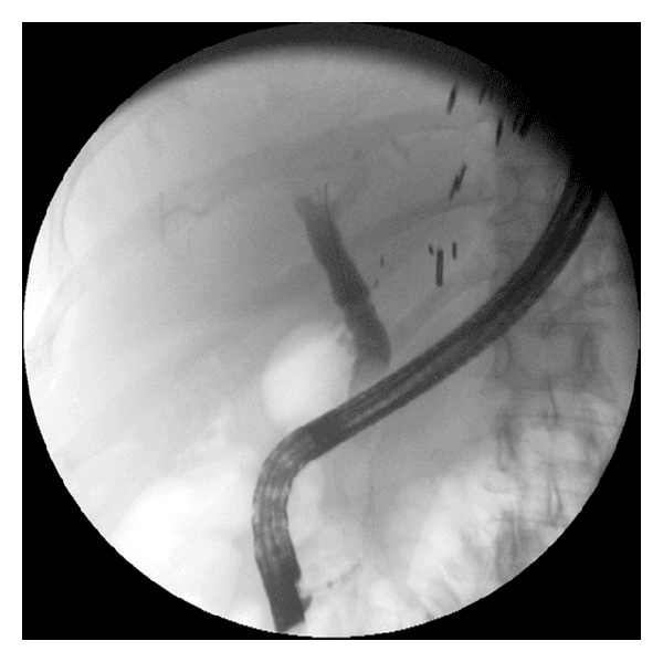 **Imaging Modality:** Fluoroscopic image obtained during Endoscopic Retrograde Cholangiopancreatography (ERCP).
**Anatomical Region:** Upper gastrointestinal tract and biliary system, specifically the duodenum and common bile duct (CBD).
**Key Landmarks and Devices:** A flexible, radiopaque side-viewing duodenoscope is positioned within the descending duodenum. Surgical clips are visible in the right upper quadrant, suggesting prior cholecystectomy or hepatobiliary surgery. The vertebral column is visible on the right aspect of the frame.
**Observed Findings:** Opacification of the extrahepatic biliary tree is achieved via contrast injection. The common bile duct (CBD) demonstrates a patent lumen with a relatively uniform diameter. There is a notable absence of high-grade focal narrowing or filling defects within the visualized segment of the duct. Contrast flow appears to transit through the biliary system without significant obstruction.
**Diagnostic Features:** The image illustrates the post-intervention state of the biliary tree, confirming the resolution of a previously documented biliary stricture. The caliber of the CBD is preserved, and there is no residual proximal ductal dilation visible in this view.