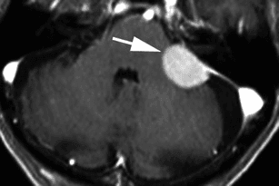 **Imaging Modality:** Post-contrast axial T1-weighted MRI of the brain.
**Anatomical Region:** Posterior fossa, specifically the left cerebellopontine angle (CPA).
**Observed Pathology:** A well-circumscribed, extra-axial mass is located within the left CPA (indicated by arrow). The lesion demonstrates intense, homogeneous contrast enhancement and exhibits a broad-based dural attachment along the petrous temporal bone. A linear enhancement extending from the lesion's margins, consistent with a "dural tail sign," is visible.
**Characteristic Visual Features:** The mass is located adjacent to the left internal acoustic meatus (IAM) but remains extracanalicular, showing no significant extension into the meatus. It exerts mild mass effect on the adjacent cerebellar hemisphere and brainstem without visible edema on this sequence.
**Diagnostic Differentiating Features:** The broad dural base, homogeneous enhancement, dural tail sign, and lack of internal acoustic canal widening are radiologic features characteristic of a grade I meningioma, distinguishing it from an acoustic neuroma (vestibular schwannoma).