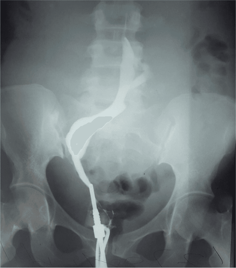 **Imaging Modality:** Hysterosalpingogram (HSG); fluoroscopic contrast study.
**Anatomical Region:** Female pelvis, specifically the uterus and fallopian tubes.
**Observed Pathology:** Intrauterine synechiae (Asherman syndrome).
**Characteristic Visual Features:**
The image demonstrates a hysterosalpingogram showing the uterine cavity opacified with radiopaque contrast media. The uterine contour is highly irregular and distorted. Key findings include multiple well-defined, linear, and irregular radiolucent filling defects within the contrast-filled uterine body. These filling defects represent intrauterine adhesions or synechiae that bridge the uterine walls, preventing uniform contrast distribution.
**Differentiating Features:**
The presence of sharp, angular, and non-mobile filling defects distinguishes synechiae from air bubbles (which are typically rounded and mobile) or endometrial polyps and fibroids (which usually present as smooth, rounded intraluminal masses). There is limited visualization of normal cornual anatomy, and no definitive bilateral tubal spillage is observed in this view, suggesting significant cavitary obliteration.