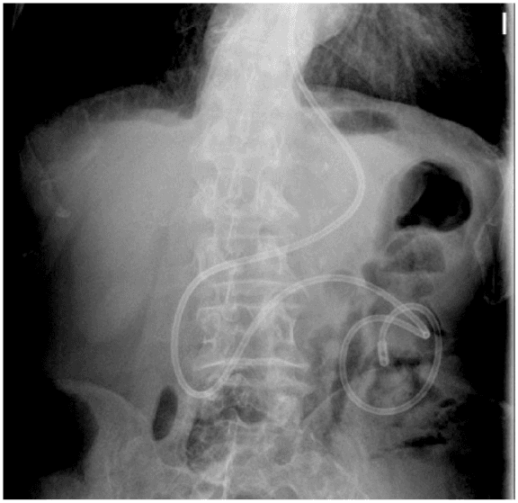 **Imaging Modality:** Anteroposterior (AP) abdominal X-ray (radiograph).
**Anatomical Region:** Upper abdomen and lower thorax, including the vertebral column, diaphragm, stomach, and proximal small bowel loops.
**Observed Device/Pathology:** A radiopaque enteral feeding tube, identified as a nasojejunal (NJ) tube, is visualized. The tube traverses the esophagus and gastric body, crosses the midline at the level of the pylorus/duodenum, and extends inferiorly and laterally.
**Characteristic Visual Features:**
- **Course:** The tube descends through the midline, curves along the greater curvature of the stomach, passes through the duodenum, and terminates with the distal tip and weighted bolus positioned in the left upper quadrant, consistent with the proximal jejunum beyond the Ligament of Treitz.
- **Skeletal Findings:** Mild thoracolumbar scoliosis is noted.
- **Soft Tissue/Air:** Gastric and colonic gaseous distension is visible in the left upper and lower quadrants.
**Key Diagnostic Features:** The post-pyloric position of the radiopaque tip confirms correct nasojejunal placement for enteral nutrition, distinguishing it from a nasogastric (NG) tube which would terminate within the gastric bubble.