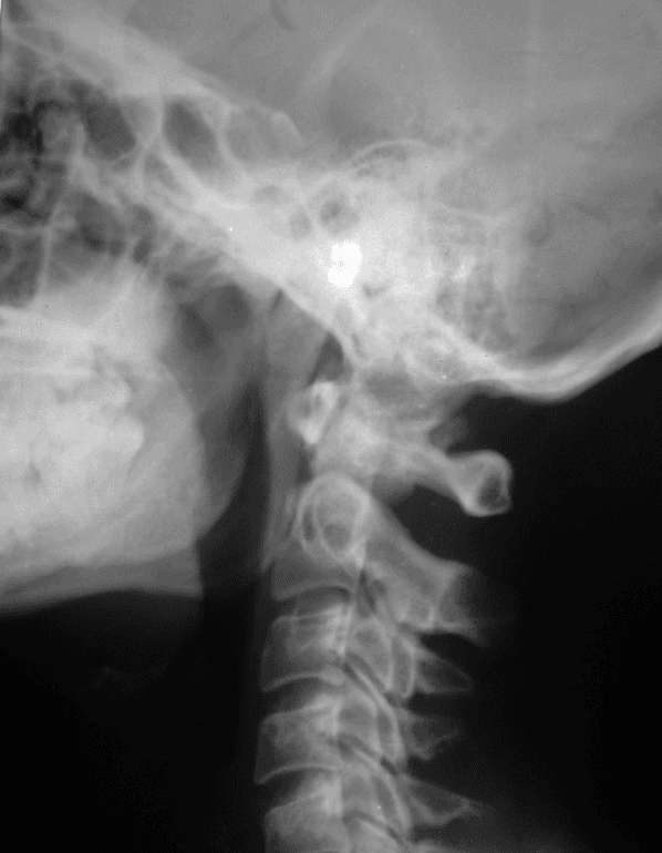 **Modality:** Lateral projection plain radiograph (X-ray).
**Anatomic Region:** Upper cervical spine and skull base, including the craniovertebral junction and oropharyngeal soft tissue area.
**Observations:**
The image demonstrates a prominent, elongated, and heavily ossified structure originating from the styloid process at the skull base. This radiopaque structure extends anteroinferiorly and caudally toward the level of the hyoid bone. The ossification appears continuous and robust, occupying the lateral cervical space. The cervical vertebrae (C1-C5 visible) show preserved alignment and disc heights, though there is superimposed radiopacity from the ossified ligament over the upper cervical segments.
**Pathology/Clinical Entity:**
The findings are highly characteristic of **Eagle syndrome** (stylohyoid syndrome), specifically demonstrating complete or near-complete **ossification of the stylohyoid ligament**.
**Key Diagnostic Features:**
- Significant elongation and mineralization of the styloid process.
- Continuous radiopaque band extending to the hyoid bone.
- Differentiation from vascular calcification based on the linear, anatomical trajectory of the stylohyoid apparatus.