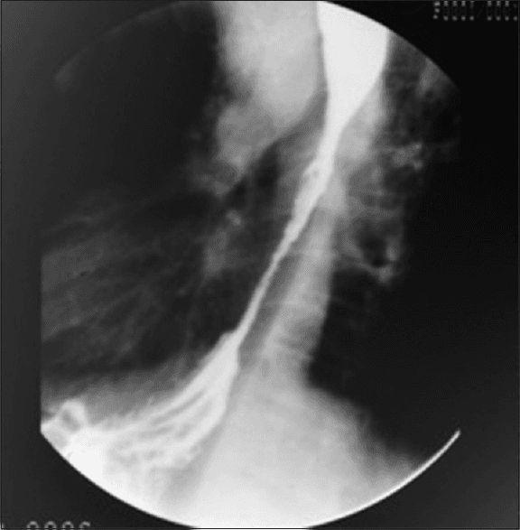 **Imaging Modality:** Barium swallow (fluoroscopic contrast esophagram).
**Anatomical Region:** Lower third of the esophagus extending to the gastroesophageal junction (GEJ).
**Observed Pathology:** Long-segment, high-grade luminal narrowing (stricture) of the distal esophagus. The stricture appears irregular with significant reduction in the diameter of the barium column.
**Characteristic Visual Features:**
* **Proximal Dilatation:** There is mild pre-stenotic dilatation of the mid-esophagus above the level of the narrowing.
* **Stricture Morphology:** The narrowing demonstrates tapered, "rat-tail" or "bird-beak" like appearance as it approaches the diaphragm, though the mucosal irregularity suggests an organic rather than purely functional etiology.
* **Contrast Flow:** Delayed passage of contrast media through the stenotic segment into the gastric cardia.
* **Mucosal Pattern:** Loss of normal longitudinal mucosal folds within the strictured zone, replaced by an irregular, thread-like contrast trail.
**Diagnostic Context:** Findings are highly suggestive of an organic lower esophageal stricture, frequently associated with advanced gastroesophageal reflux disease (peptic stricture) or malignant infiltration (esophageal carcinoma). The imaging differentiates this from achalasia by the degree of luminal irregularity and the length of the involved segment.